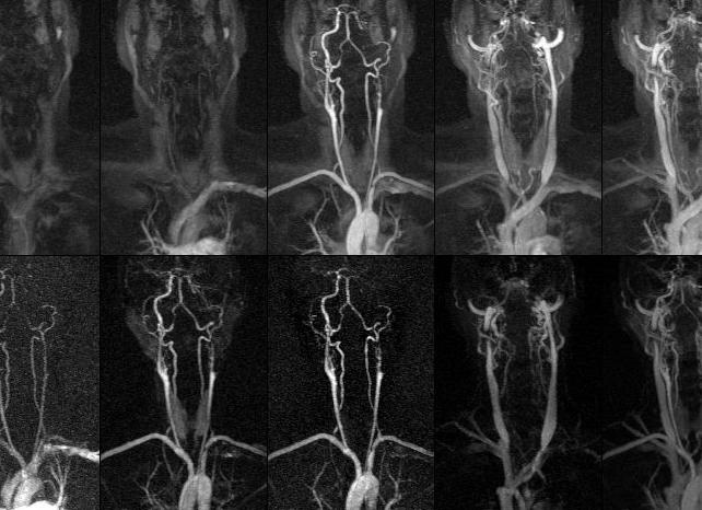 Что лучше мрт или узи сосудов головного мозга и шеи