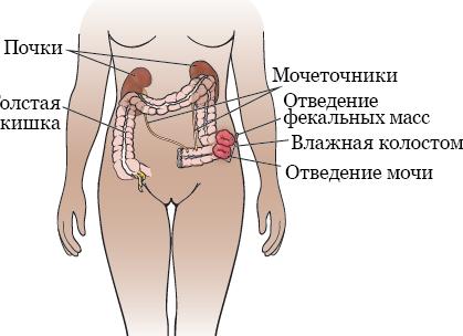 Что это значит если в моче ацетон Что это значит если в моче ацетон