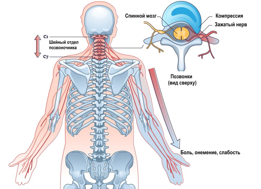 Болезнь клиппеля фейля фото