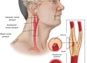 Атеросклероз брахиоцефальных артерий Атеросклероз брахиоцефальных артерий