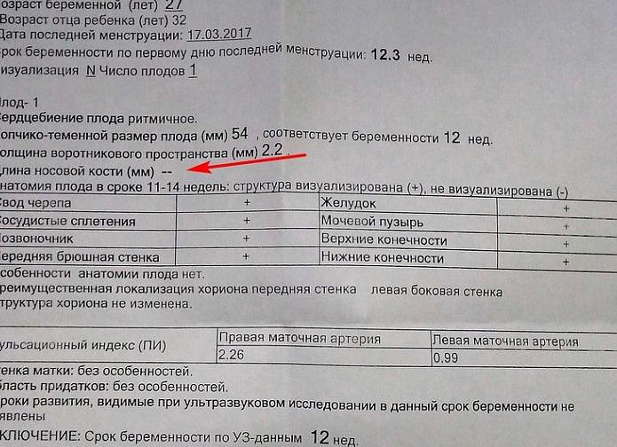 Анализ на дауна