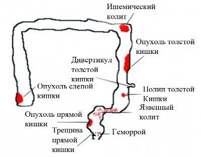 Кровь в кале у взрослого
