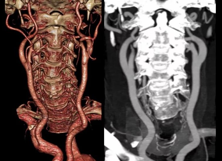 Мрт или кт позвоночника
