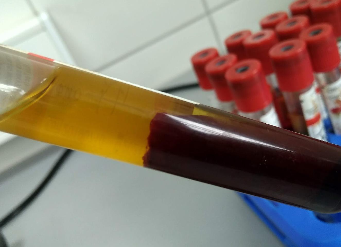 Кровь свернулась при анализе