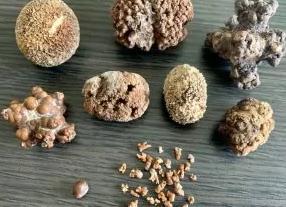 Как определить камень в почке