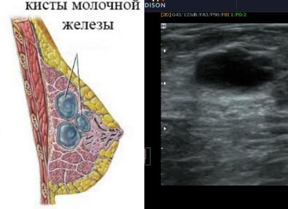 Как избавиться от кисты в молочной железе