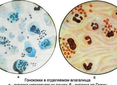 Гонококки в мазке у женщин расшифровка