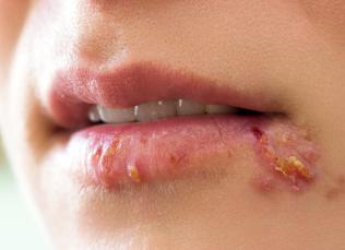 Герпес в крови как лечить