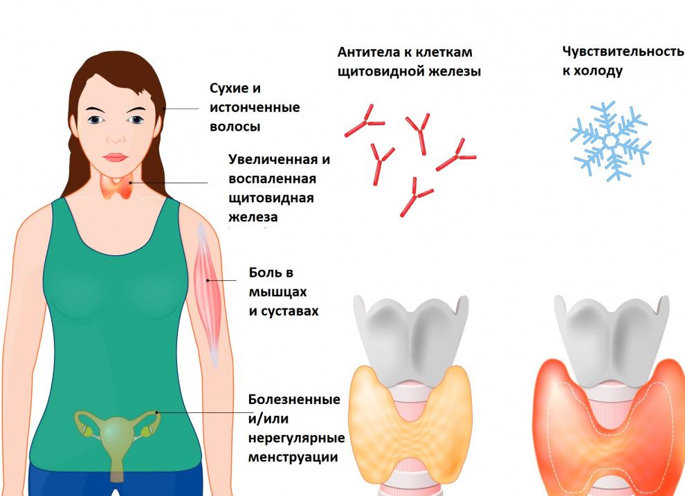 Диагностика аутоиммунного тиреоидита