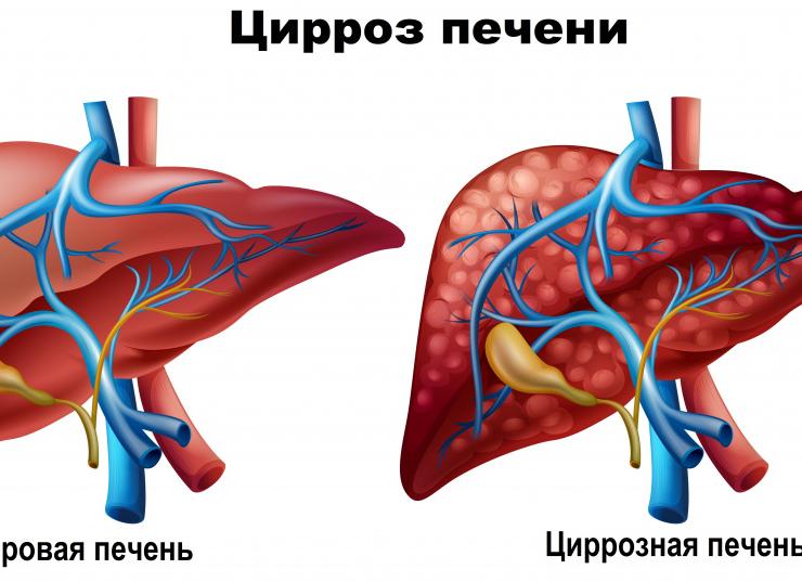 Щелочная фосфатаза понижена