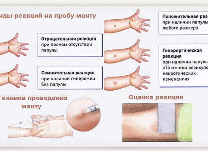 Что такое прививка манту и от чего она Что такое прививка манту и от чего она