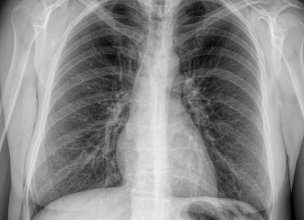 Что такое флюорография легких