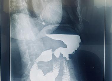 Что показывает рентген пищевода с барием