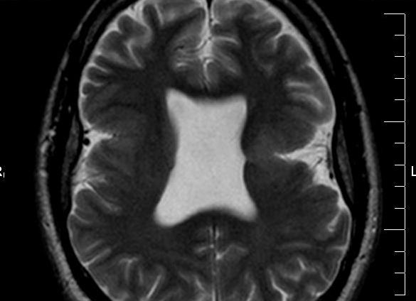 Агенезия прозрачной перегородки головного мозга