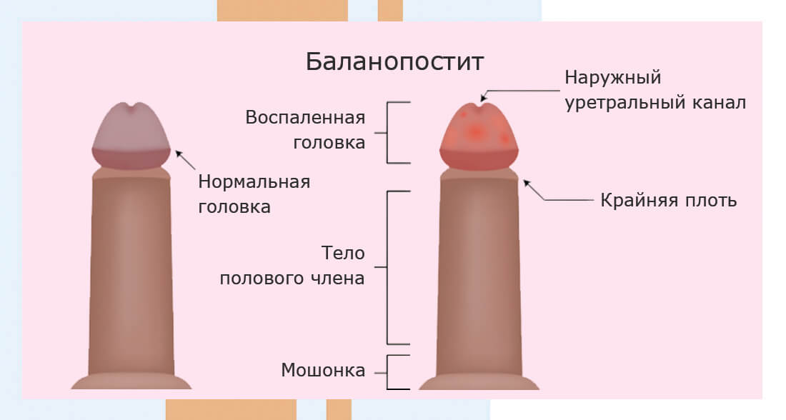 Кандидозный баланопостит фото у мужчин