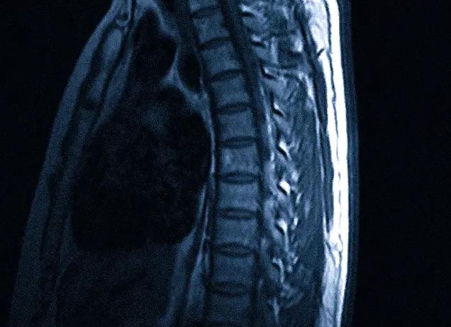Мрт позвоночника расшифровка Мрт позвоночника расшифровка