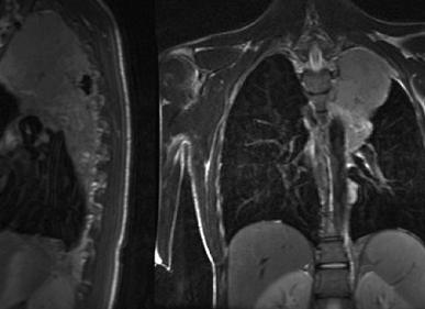 Мрт мягких тканей грудной клетки