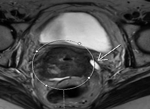 Мрт и рак матки