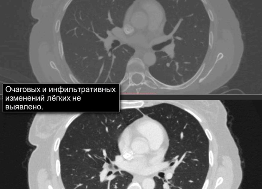 Легочные поля без очаговых и инфильтративных теней Легочные поля без очаговых и инфильтративных теней