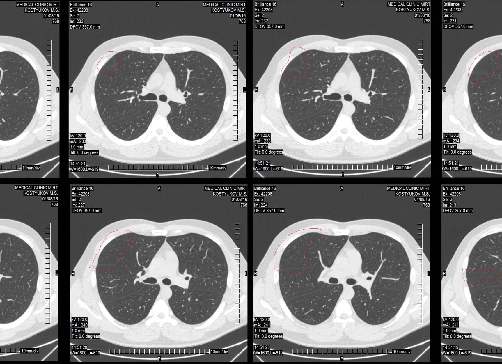 Кт грудной клетки что такое