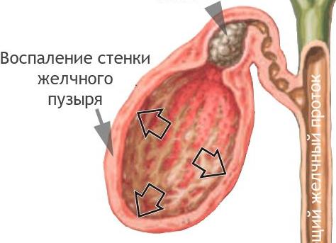 Как снять боль в желчном пузыре при камнях