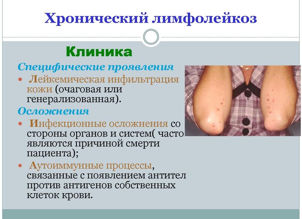 Хронический лимфолейкоз осложнения