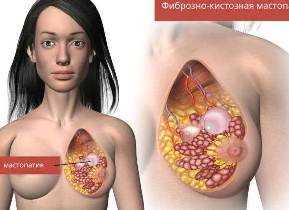 Фиброзно кистозная мастопатия болит