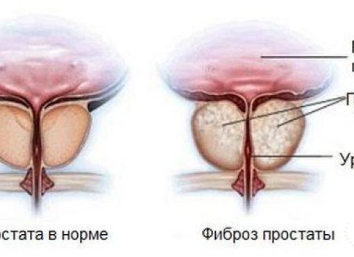 Фиброз в простате