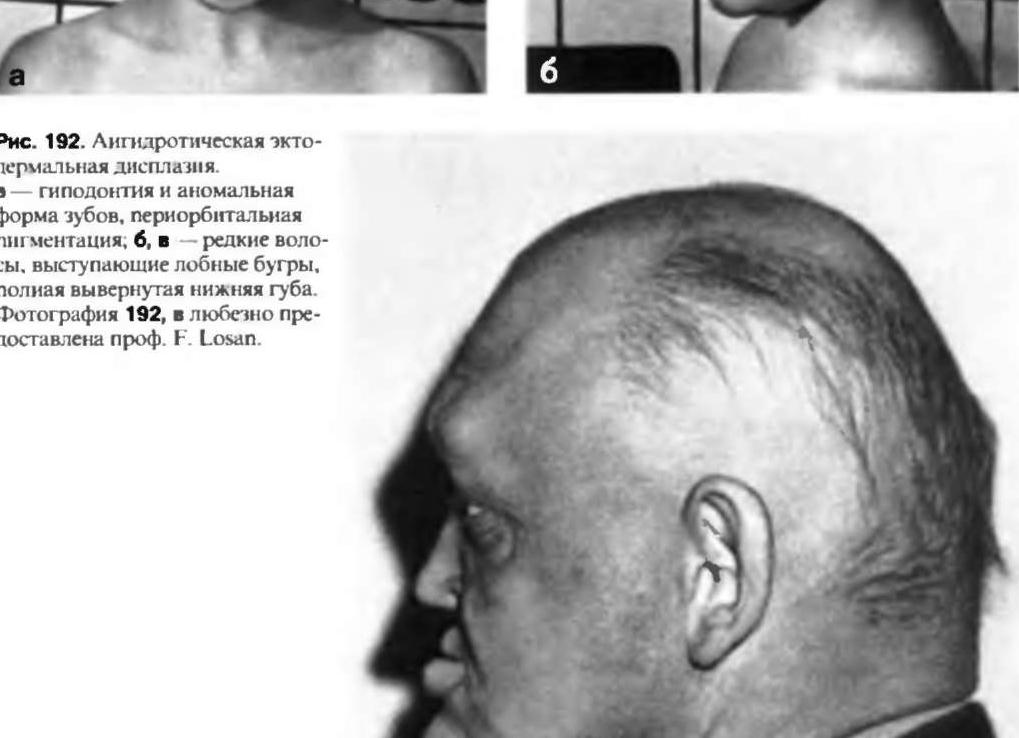 Эктодермальная дисплазия фото