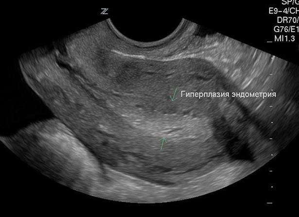 Эхопризнаки гиперплазии эндометрия в менопаузе