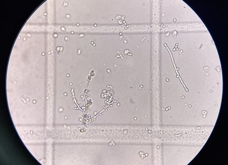 Дрожжи в моче