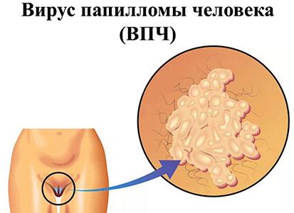 Что такое вирус папилломы человека
