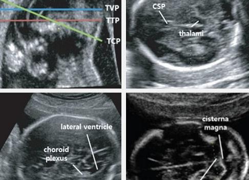 Большая цистерна плода