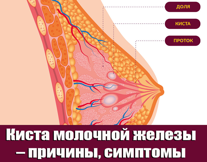 Киста в груди
