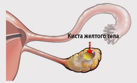 Киста желтого тела правого яичника что это