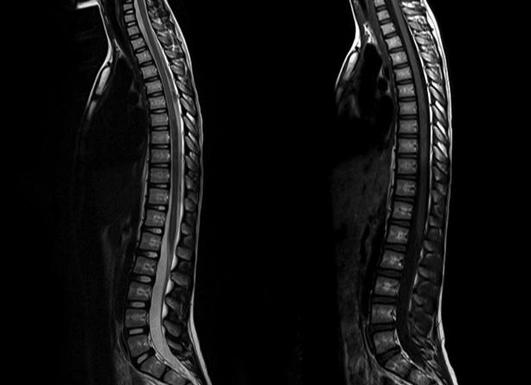 Мрт здорового позвоночника фото