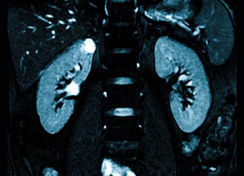 Мрт почек с контрастированием