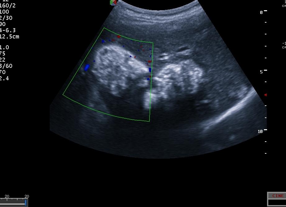 Можно ли определить рак по узи печени