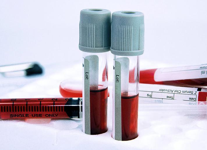 Может ли показать общий анализ крови вич