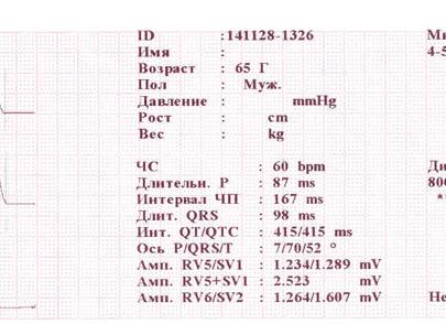 Ли результаты экг Ли результаты экг