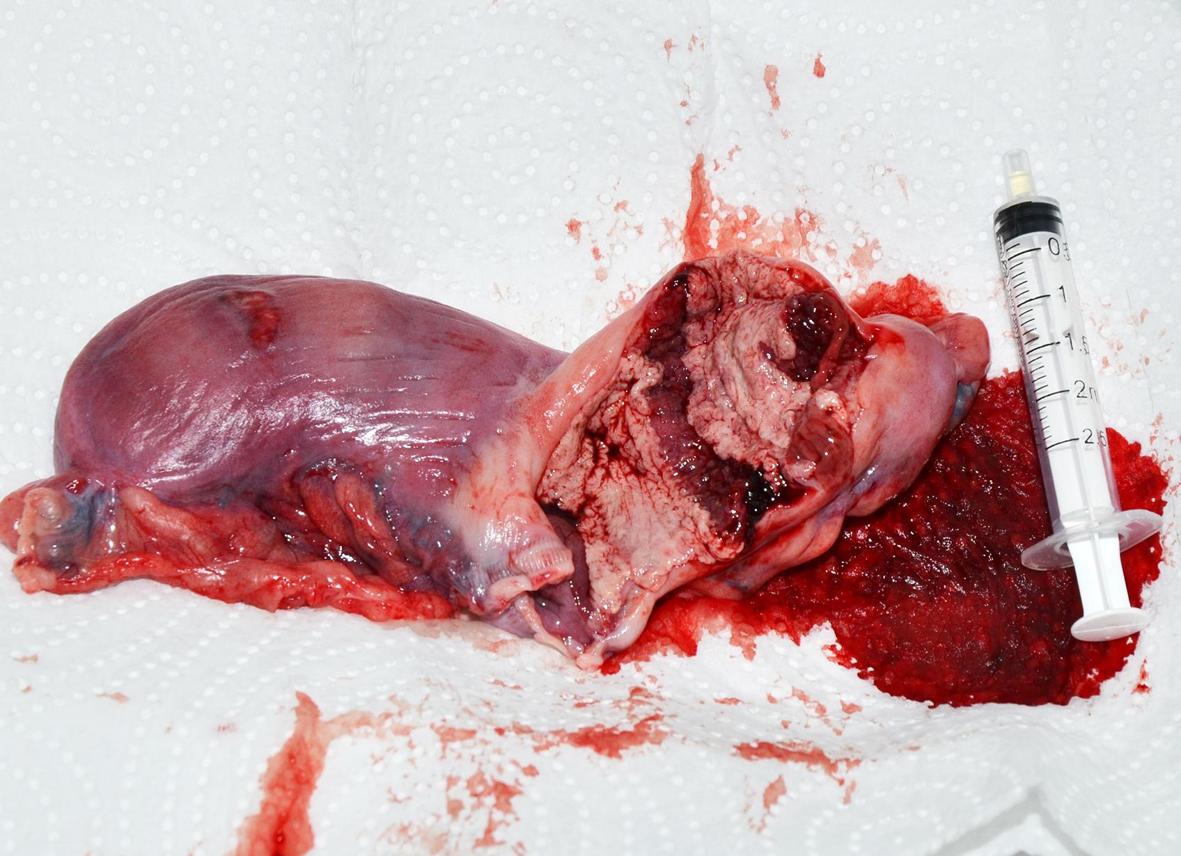 Лейкоциты в крови повышены после родов