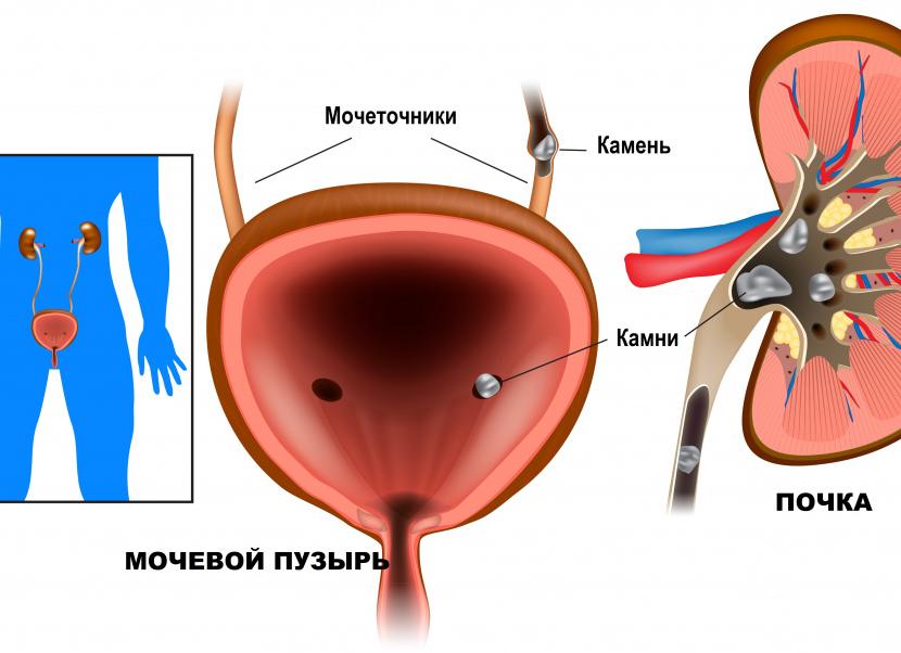 Кристаллы ураты в моче что это значит