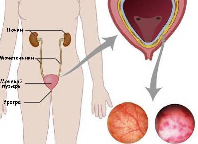 Коккобациллы у мужчин