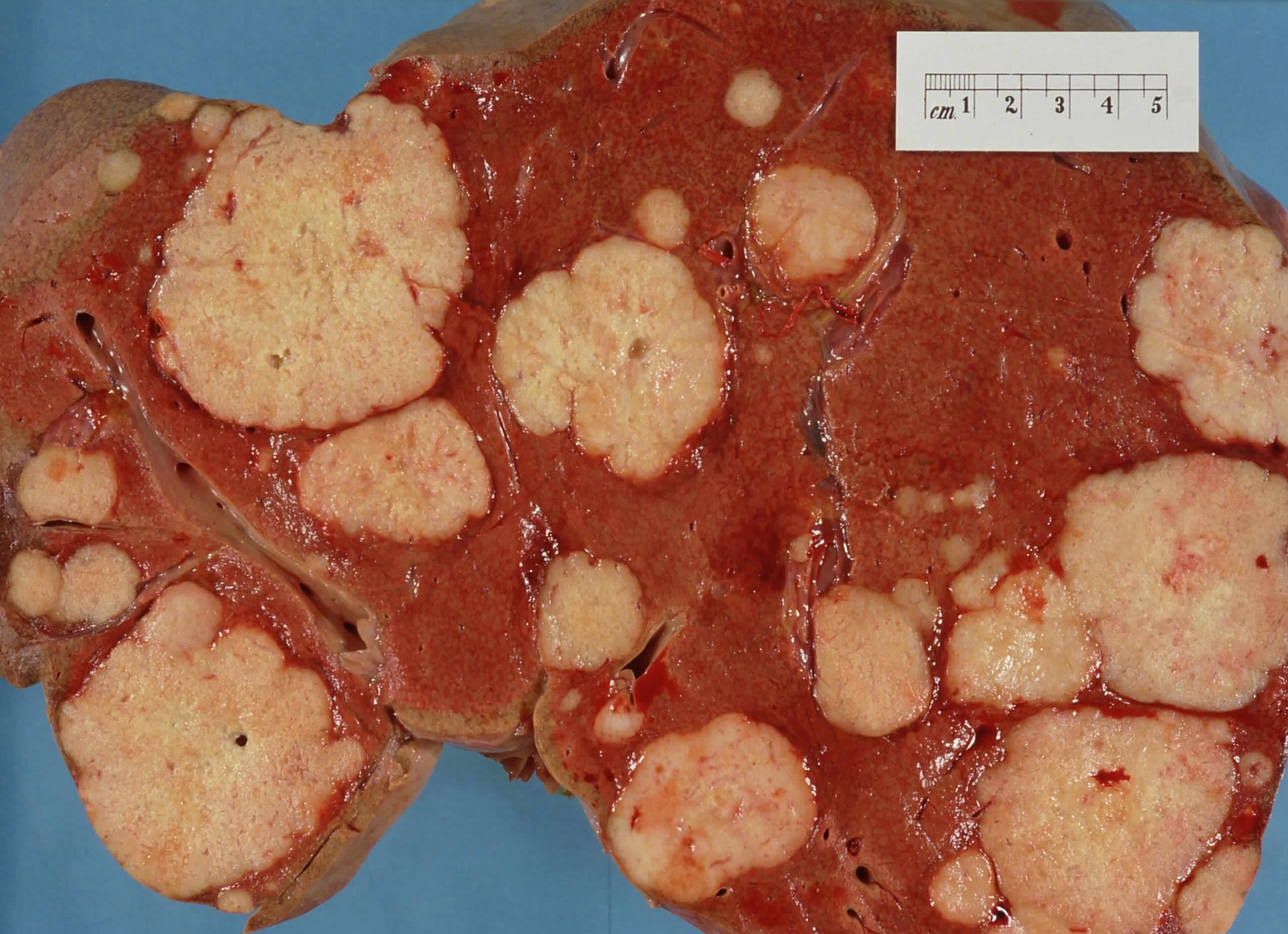 Как выглядят метастазы рака фото