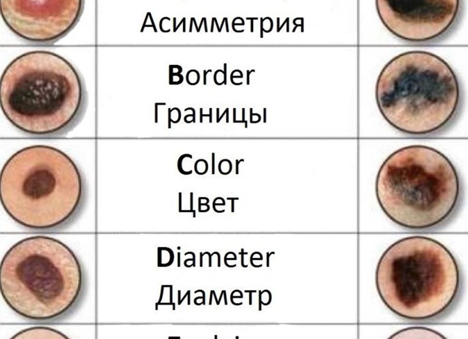 Как выглядит рак болезнь фото