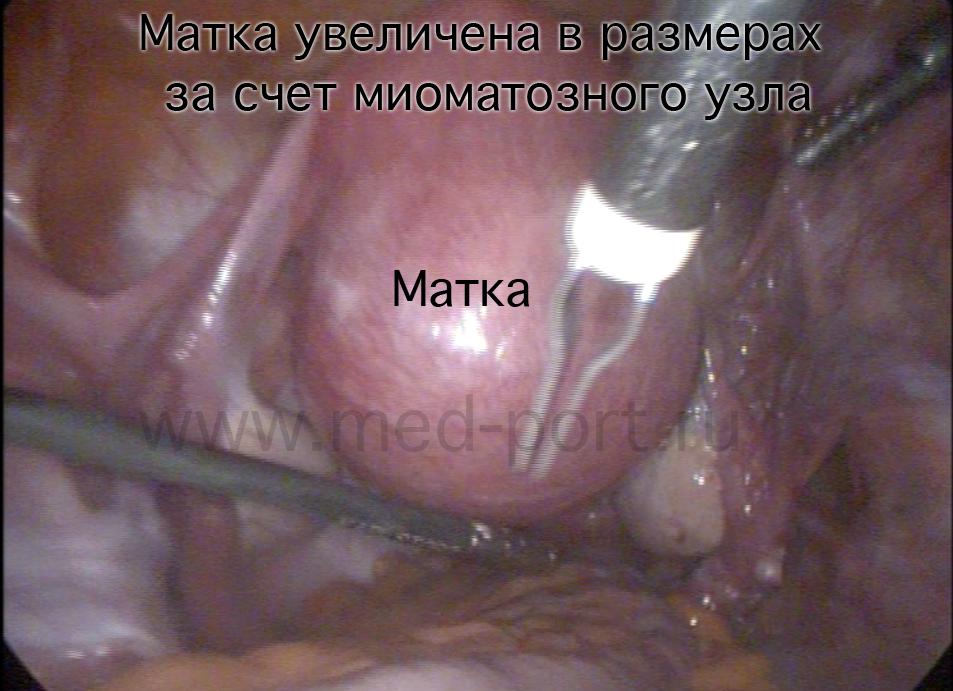 Как выглядит миома