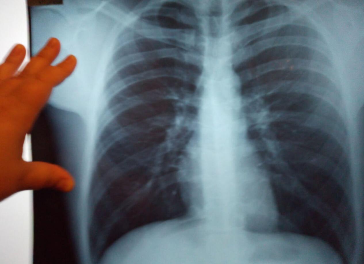 Как на флюорографии выглядят здоровые легкие
