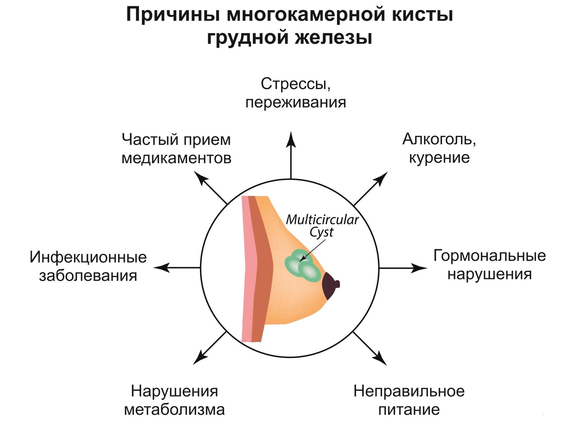 Как лечить кисты в груди Как лечить кисты в груди