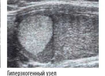 Гипоэхогенное образование щитовидной железы Гипоэхогенное образование щитовидной железы
