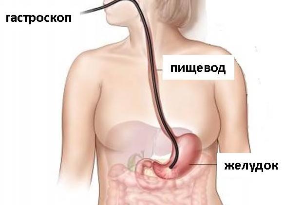 Гастроскопия что это за процедура